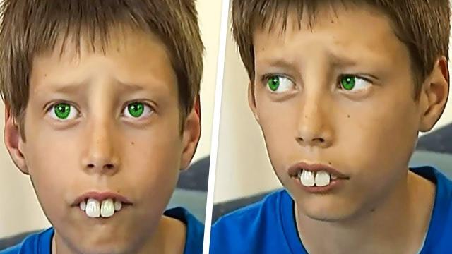 School Boys Laughed At His Rabbit Teeth But a Few Years Later He Surprised Everyone !