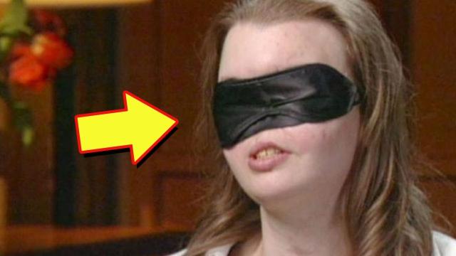 She Lost Half Her Face In 1999, Here’s What She Looks Like After Getting A New One