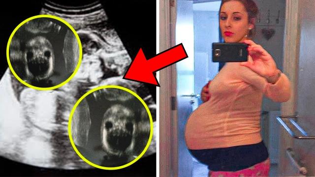 Mom's Belly Won't Stop Growing After Birth - Doctor Can't Believe His Eyes After Seeing Ultrasound