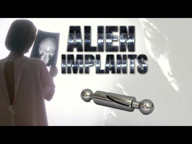 Strange Miniature Devices Are Found in Human Beings Worldwide ! ALIEN Implants ? ????