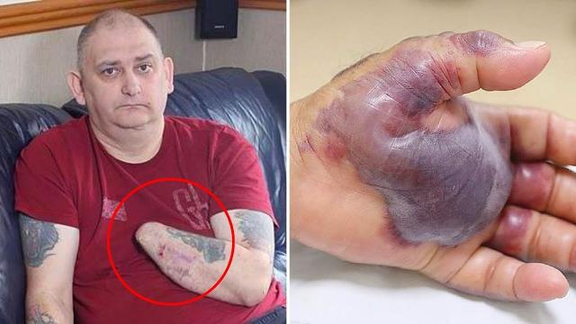 The Reason Why Doctors  Amputate Man's Arm Will Shock You