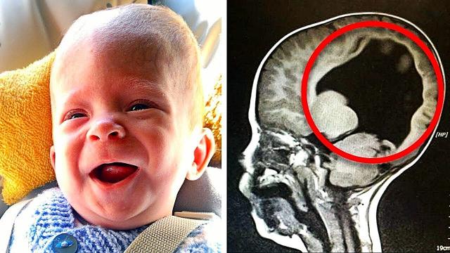 Boy Born Without A Brain, 6 Years Later Look At What Doctors Find Inside