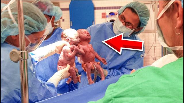 Woman Gives Birth To Semi-Identical Twins: Doctors Left 'Totally Baffled'