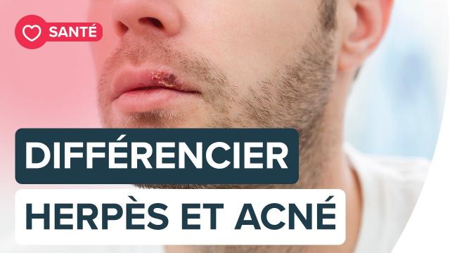 Comment différencier un bouton d’herpès labial et un bouton d’acné ? | Futura