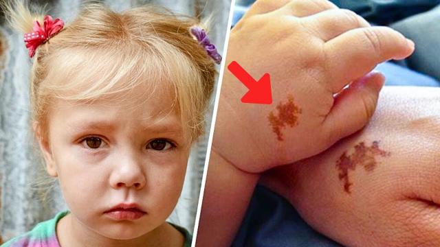 Mom Adopts Girl With Same Birthmark - She Screams When She Sees DNA Test Results