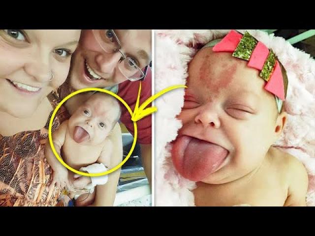 This Boy was born with a massive adult sized tongue! you won't believe what she looks like today