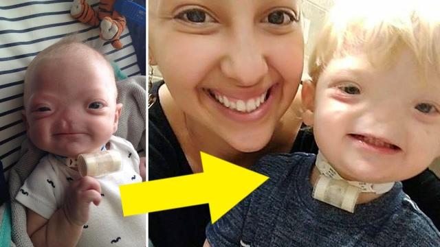 The Miracle Baby Born Without a Nose Passes Away