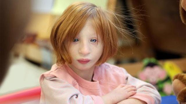 Mother adopts girl no one wanted, 19 years later she looks completely different