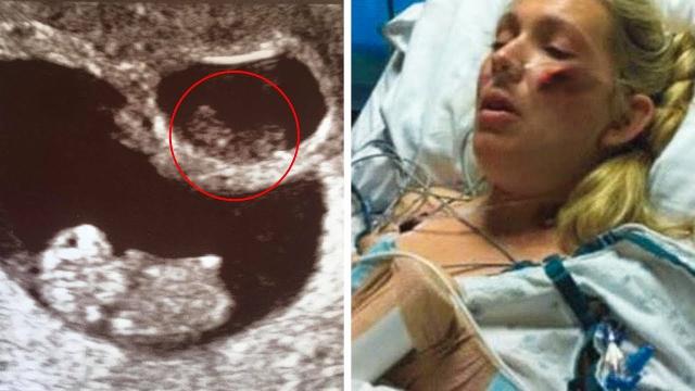 Pregnant Woman Had C-Section So He Husband Could Meet His Son For The First and Last Time !