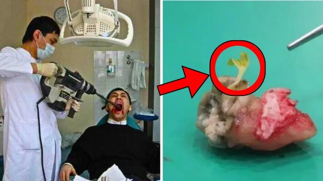 What Dentist Discovered Inside Man's Tooth Makes Him Call The News Immediately - Erie Discovery