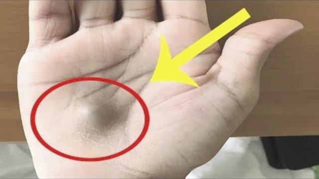 A Man Found This Strange Lump On His Palm  Then A Scan Revealed The True Cause Of This