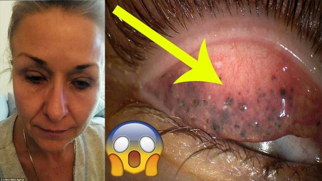 Woman Wears Mascara To Bed For 25 Years And Never Washes Her Face – See Under Her Eyelid