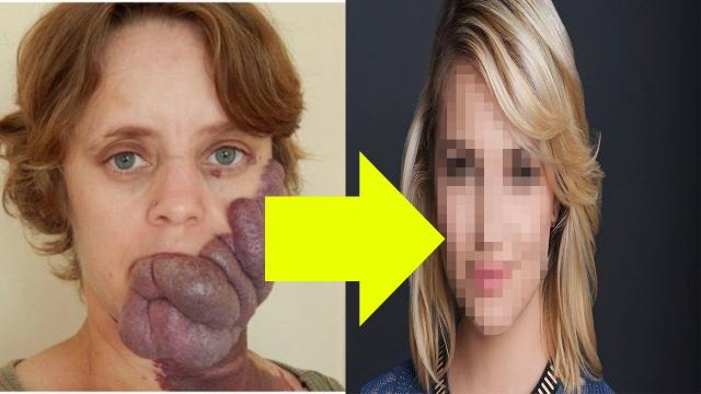 Bullies Called Her ‘Purple People Eater’ Because Of Birthmark But Her Transformation Is Amazing