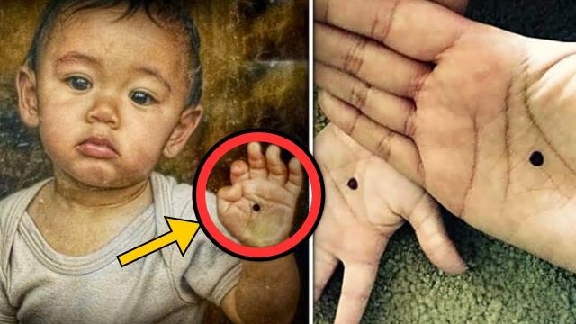 Adopted Boy Has Weird Spot On Hand - When The Doctors See It, He Calls The Police