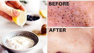 How To REMOVE BLACKHEADS FROM NOSE OR EARS with 6 Face Mask Recipes