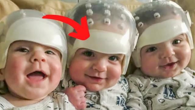 When This Woman Gave Birth To Triplets, Doctors Realized That Something Was Wrong With Their Heads