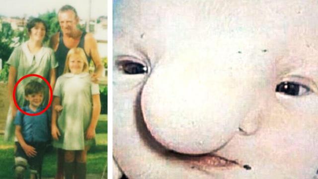 When His Mom Saw His “Ugly” Face, She Refused To Take Him Home