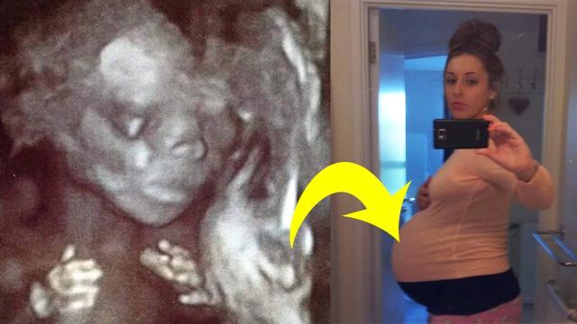 Woman’s Baby Bump Keeps Growing, Then Doctor Spots Something Unusual In Ultrasound