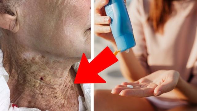 consequences of 92-year-old woman using sun cream on her face but not her neck for decades