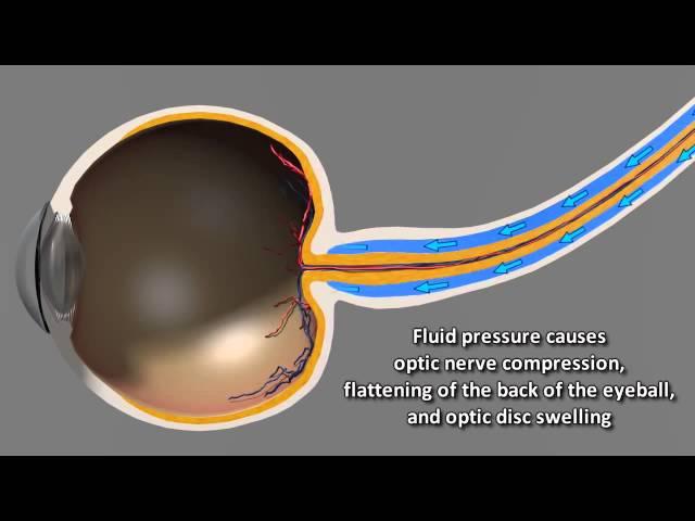 Astronauts Can Suffer Vision Impairment In Space | Video