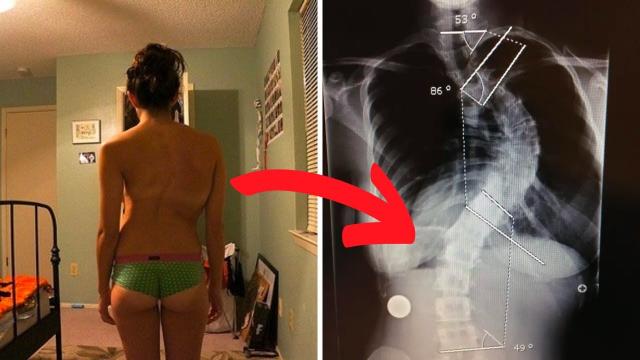 This Patient Shares Her Surgery Shocking Photos That Fixed Her Spine