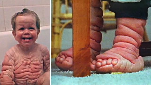 This Unique Boy Was Born With More Skin than Usual For Strange Reason !