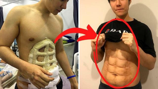 This Cosmetic Clinic Is Offering An Instant 6 Pack Surgery Option