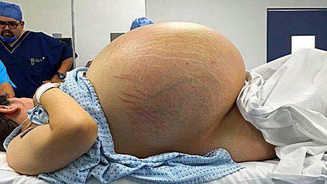 Woman Can’t Give Birth, Then Doctors Realize What’s Growing Inside Of Her