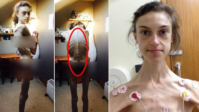 An Anorexic Woman Shares How Instagram Saved Her Life