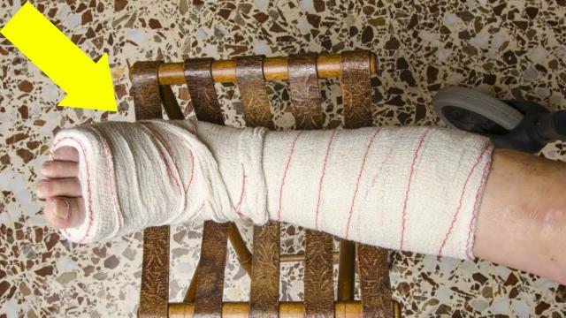 71 Year Old Woman Finds Diamonds Worth $400,000 in Her Plaster Cast