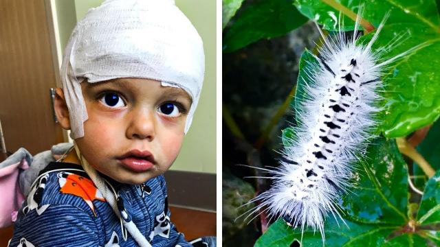 A Boy Hospitalized After Touching a Small Harmless Worm