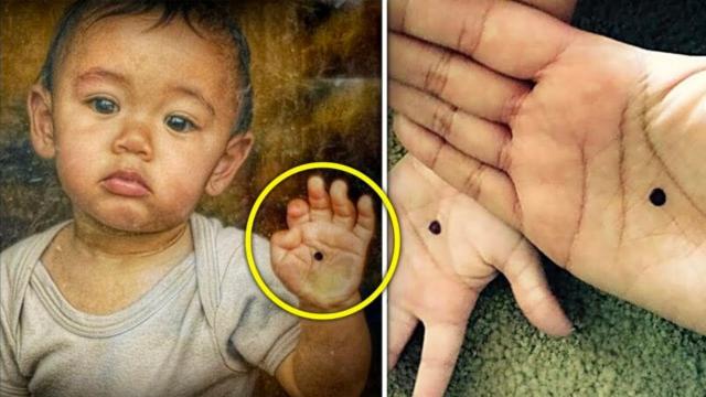 Adopted Boy Has Weird Spot On Hand - When The Doctors See It He Calls The Police