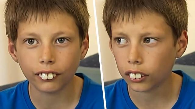 After Being Bullied For His Huge Teeth For Years, He Eventually Surprises Everyone !