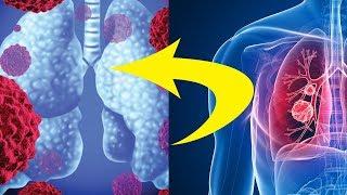 Scientists Just Discovered Lung Cancer Cells That Have Stomach And Intestines!